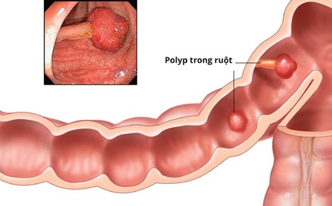 Polyp đại - trực tràng ở trẻ em